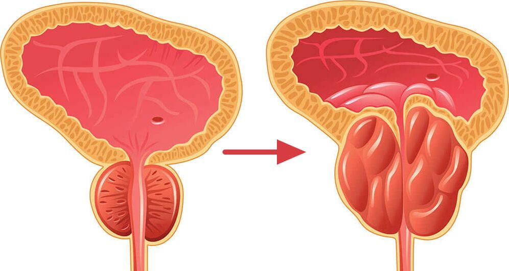 Prostata – normalna i upaljena