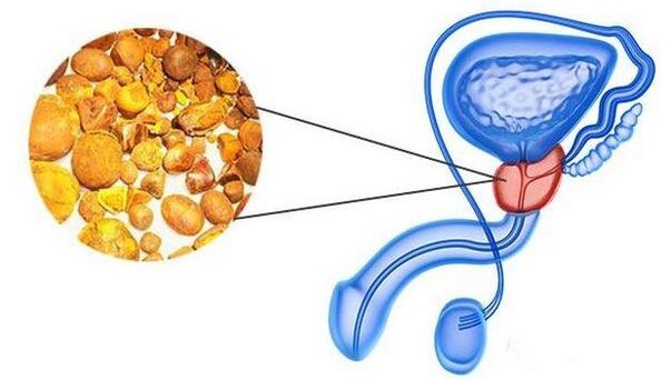 Kalcira u žlijezdi prostate
