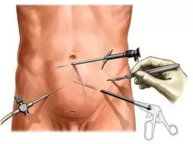 kirurško liječenje kroničnog prostatitisa