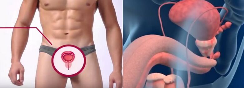 Prostatitis kod muškaraca, prepoznatljiv po određenim znakovima