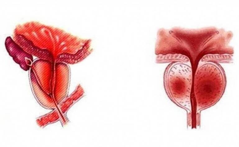 Akutna upala prostate, koja može postati kronična